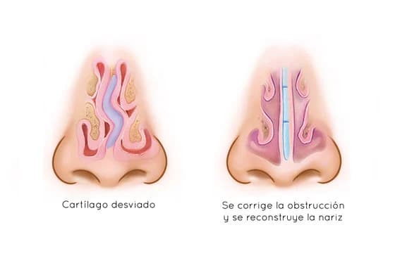 Esquema del tabique nasal