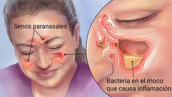 Persona con dolor facial por sinusitis