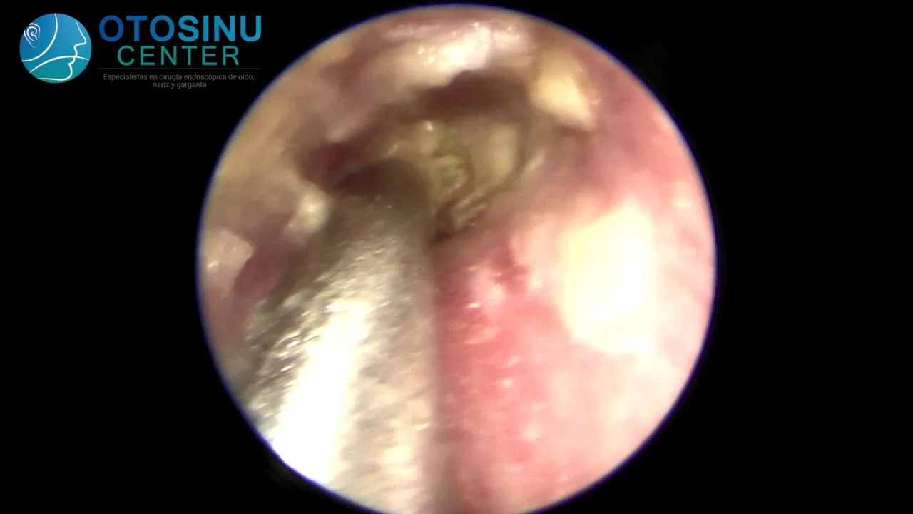 Microaspiración de oído