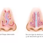 septoplastia