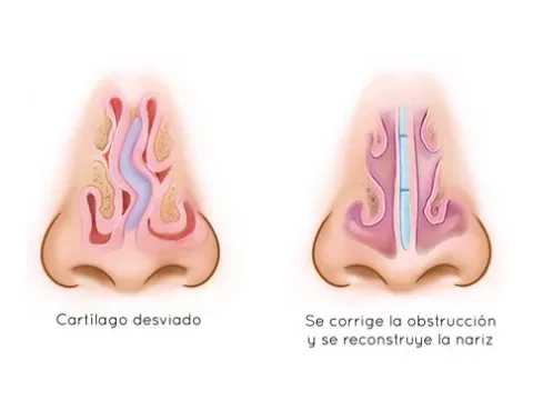 septoplastia